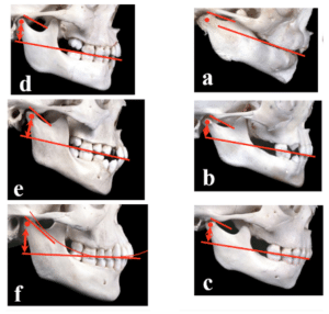 Phase I, Early Orthodontic Treatme » Frisco, TX - E Line Orthodontics